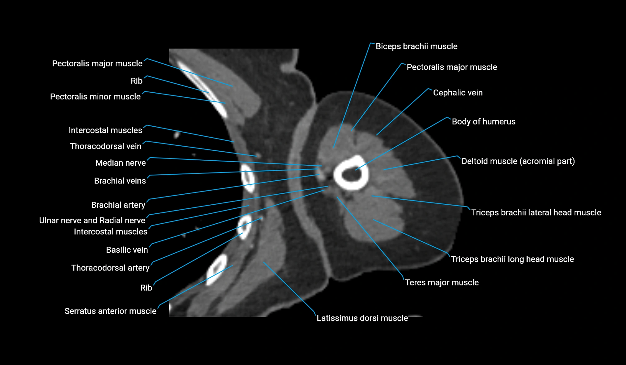 CT upper arm axial  cross sectional anatomy labelled radiology image -00178.webp